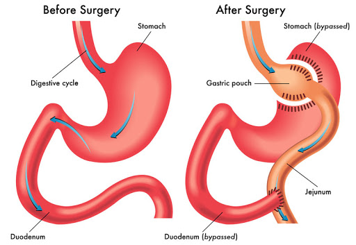 weight loss surgery